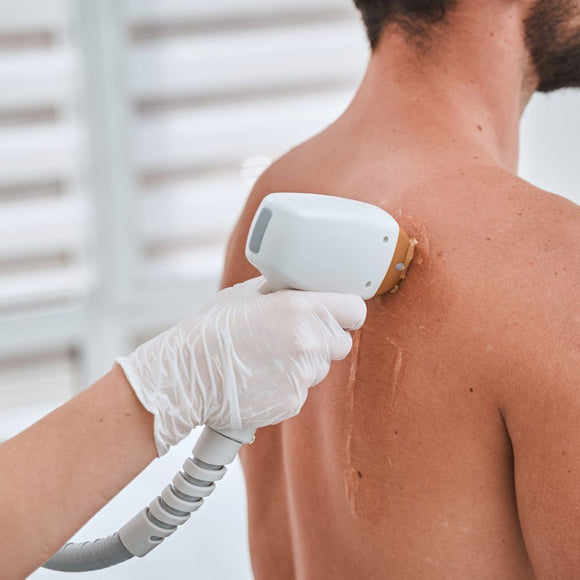 Full Back Laser Hair Removal