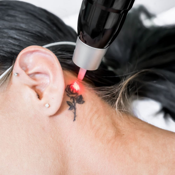 Laser Tattoo Removal 5 x 5cm