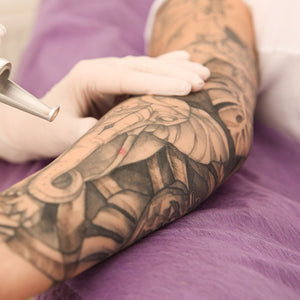 Laser Tattoo Removal Full Sleeve