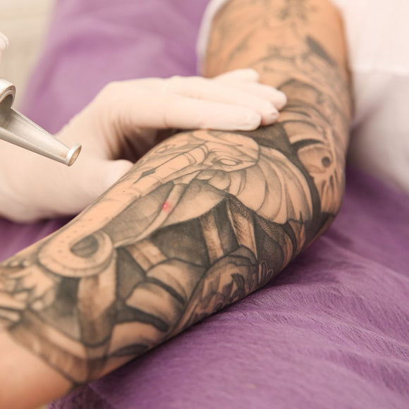 Laser Tattoo Removal Full Sleeve