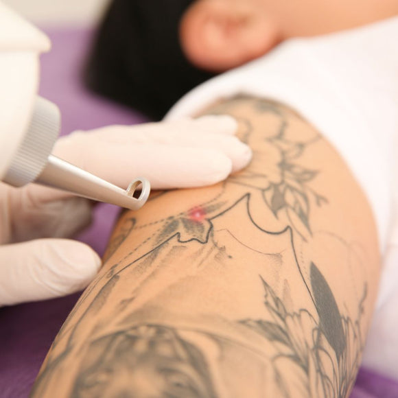 Laser Tattoo Removal Half Sleeve