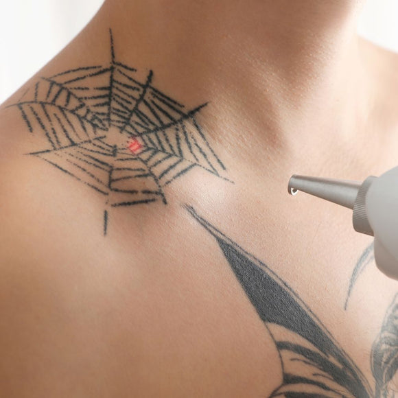 Laser Tattoo Removal 10cm x 10cm