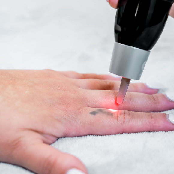 Laser Tattoo Removal (Under 5cm)