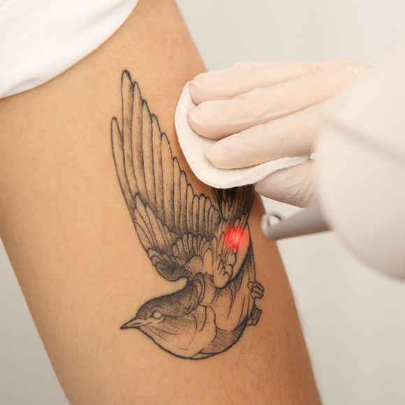 Laser Tattoo Removal 20cm x 20cm